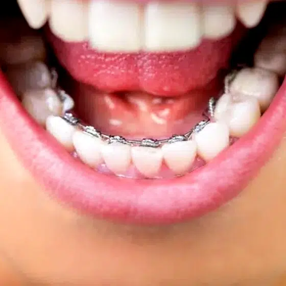 Fixed Orthodontic Retainers in Rock Hill, SC - Tripp Leitner Orthodontics
