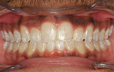 McMullen - After Braces Results | Tripp Leitner Orthodontics