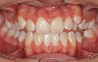 Brakefield - Before Braces Results | Tripp Leitner Orthodontics