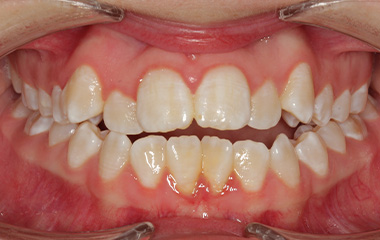 Kanipe - Before Braces Results | Tripp Leitner Orthodontics