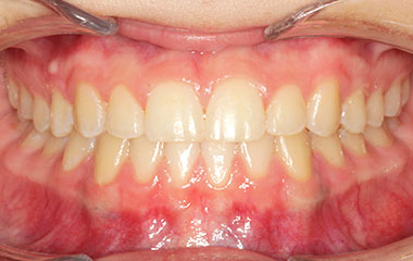Culton - After Invisalign Results | Tripp Leitner Orthodontics