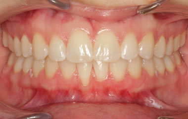 Rodgers - After Invisalign Results | Tripp Leitner Orthodontics