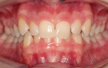 Charlotte - Image of Teeth Before Invisalign Aligners | Tripp Leitner Orthodontics - Rock Hill SC
