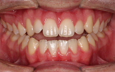 Isaac - Image of Teeth Before Invisalign Aligners | Tripp Leitner Orthodontics - Rock Hill SC