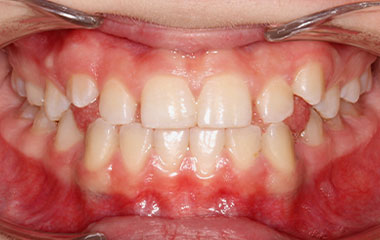 Culton - Before Invisalign Results | Tripp Leitner Orthodontics