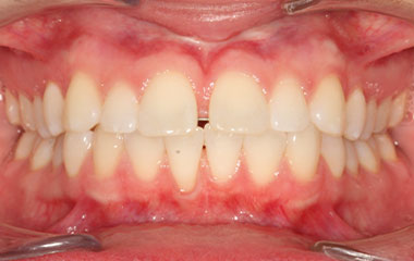 Rodgers - Before Invisalign Results | Tripp Leitner Orthodontics