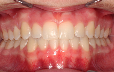 Charlotte - Image of Teeth After Invisalign Aligners | Tripp Leitner Orthodontics - Rock Hill SC
