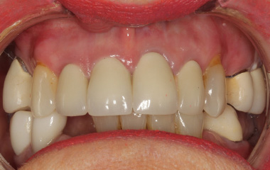 Smile Express Results | Patsy - Image of Teeth After At-Home Aligners | Tripp Leitner Orthodontics - Rock Hill SC
