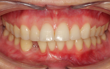 Smile Express Results | Brooke - Image of Teeth Before At-Home Aligners | Tripp Leitner Orthodontics - Rock Hill SC