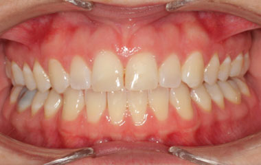 Smile Express Results | Emma - Image of Teeth Before At-Home Aligners | Tripp Leitner Orthodontics - Rock Hill SC