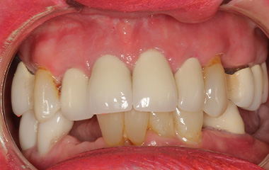 Smile Express Results | Patsy - Image of Teeth Before At-Home Aligners | Tripp Leitner Orthodontics - Rock Hill SC